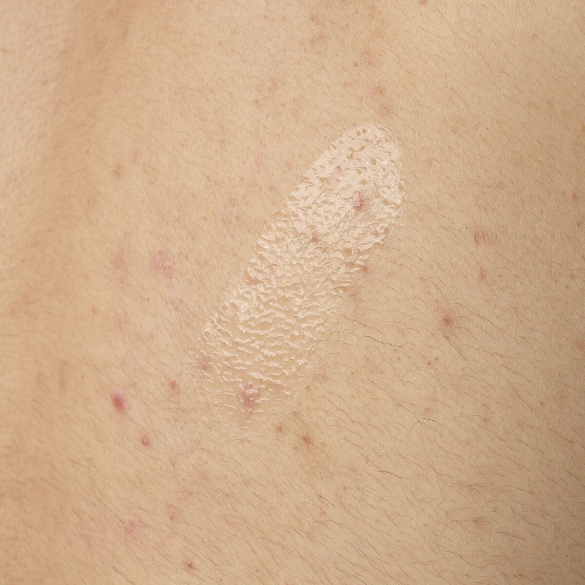 salicylic-acid-0-5-body-serum-b5 ORD-salicylic-acid-05-body-240ml-application.jpg
