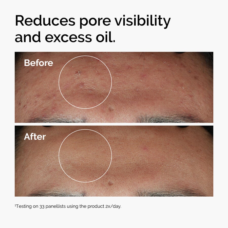 niacinamide-10-zinc-1-l7 ord-niacinamide-zinc-blemish-serum-before-after-pores.jpg