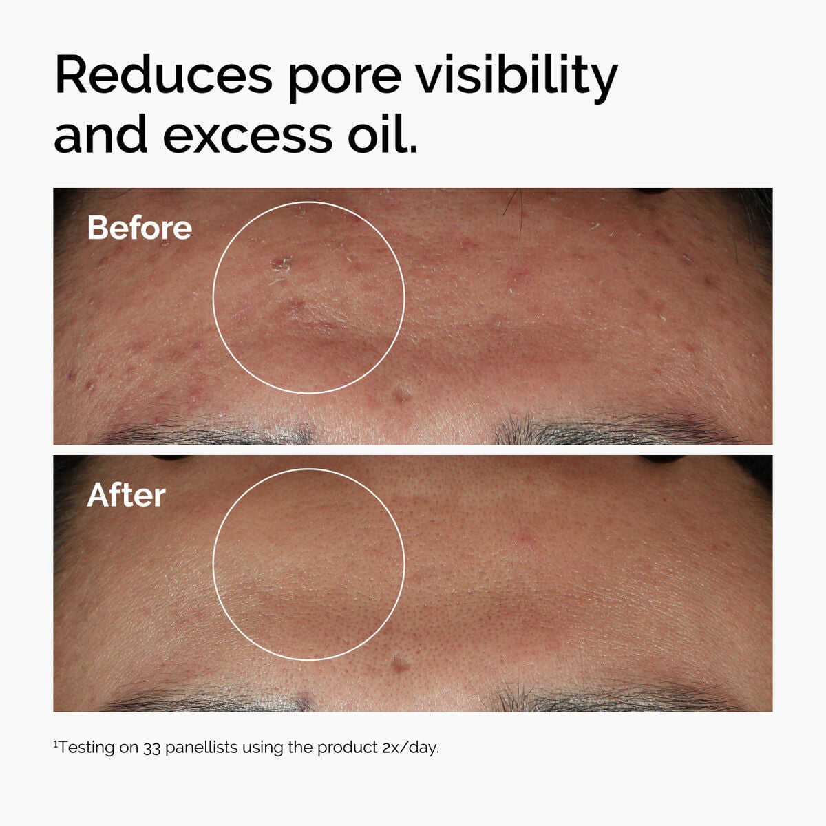 niacinamide-10-zinc-1-l7 ord-niacinamide-zinc-blemish-serum-before-after-pores.jpg