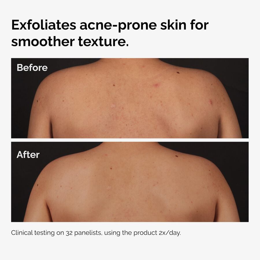 the-body-care-collection-o1 ord-salicylic-acid-body-serum-before-after-graphic-NA.jpg