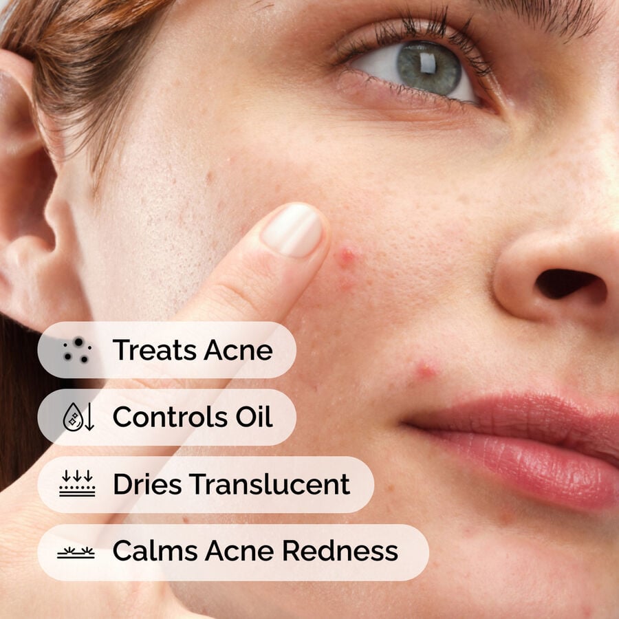 sulfur-10-powder-to-cream-concentrate-g2 ord-sulfur-10pct-powder-to-cream-concentrate-model-application-with-benefits-acne.jpg