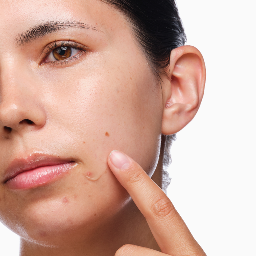 the-acne-set-m4 rdn-the-acne-set-application.png